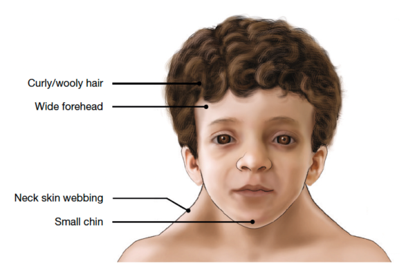 noonan syndrome adults