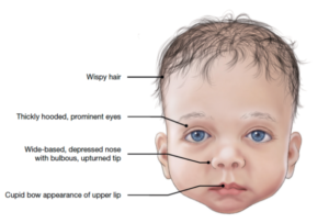 FAQs • Facial Features • Noonan Syndrome Association